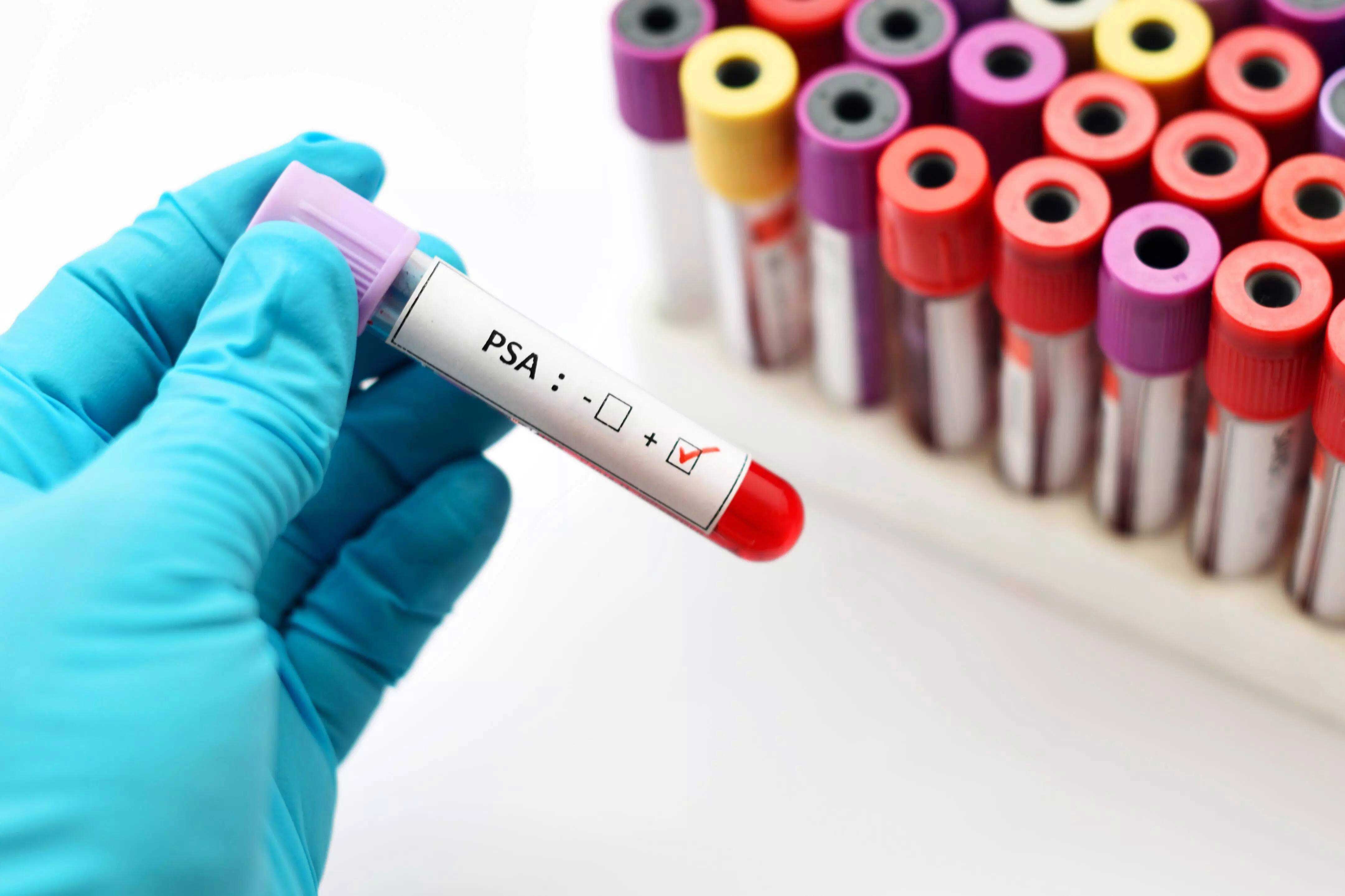 نکات لازم قبل از  آزمایش آنتی ژن اختصاصی پروستات (PSA)