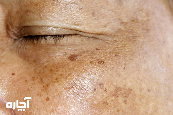  Hyperpigmentation - مراقبت از پوست در میانسالی