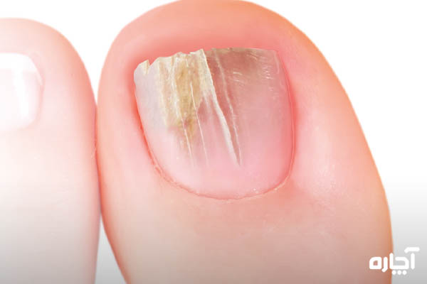 چگونه شکستگی ناخن‌های پا را ترمیم و درمان کنیم