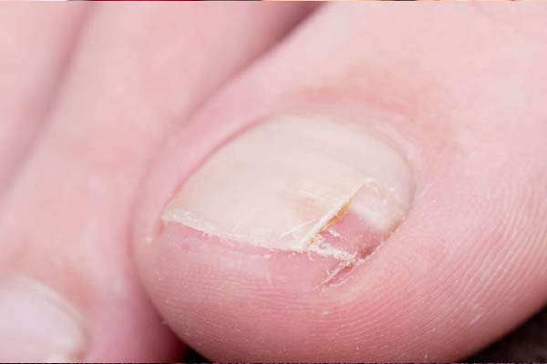 چگونه شکستگی ناخن‌های پا را ترمیم و درمان کنیم؟