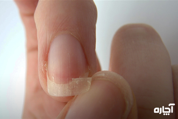 درمان شکستن ناخن دست